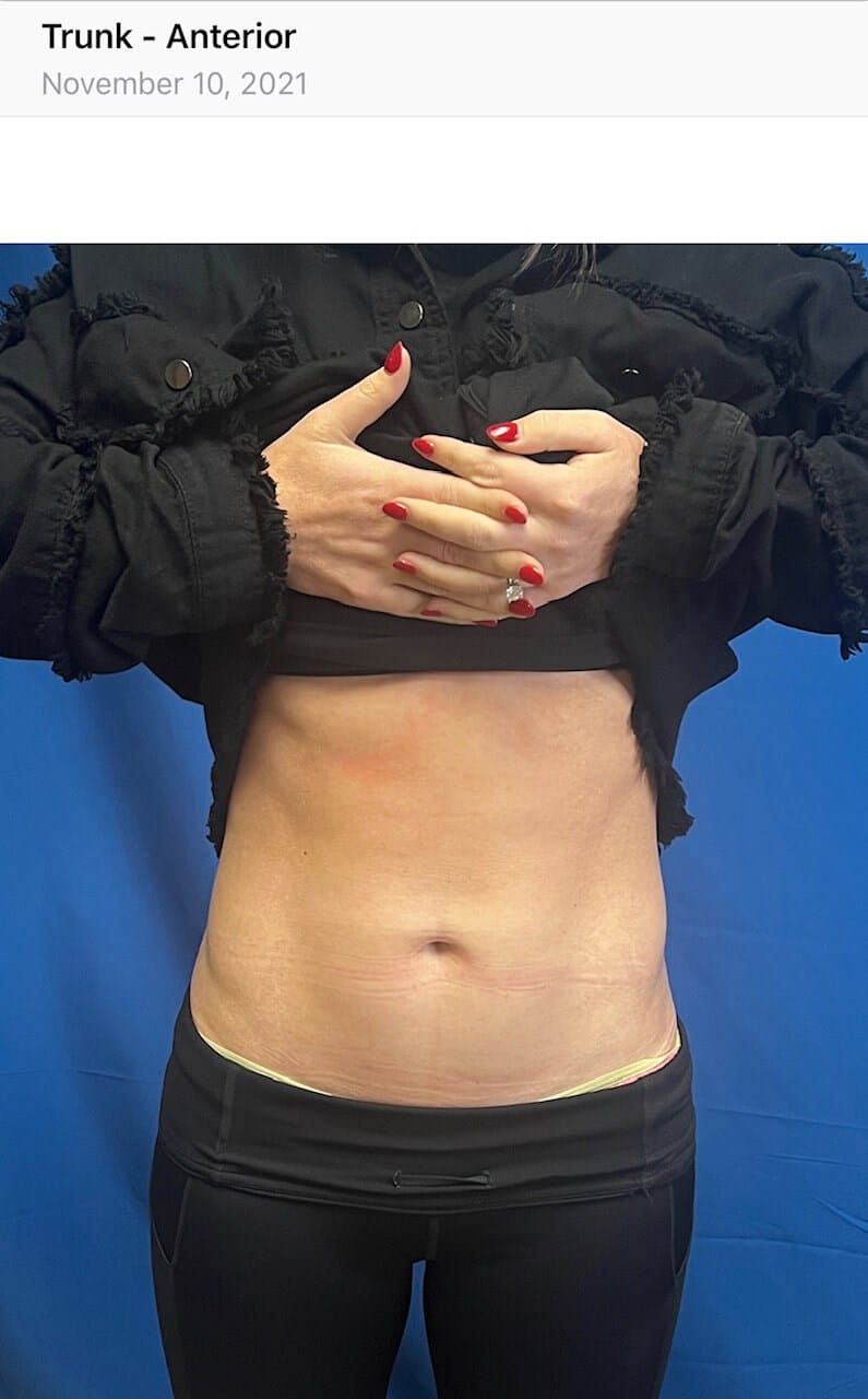 After Image: Eon Laser Fat Reduction - front