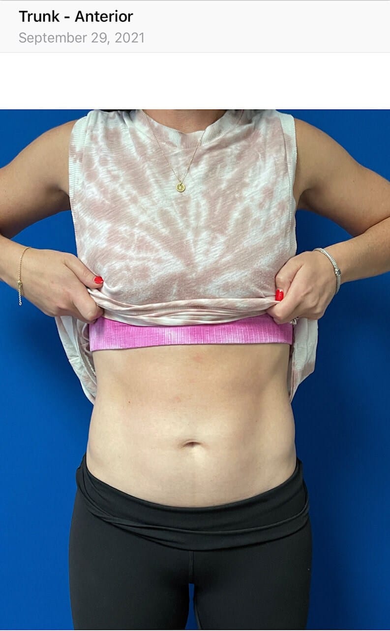 Before Image: Eon Laser Fat Reduction - front