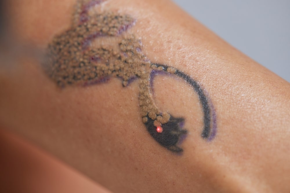Close-up of young woman undergoing laser tattoo removal procedure in salon for skin restoration and cosmetic treatment.
