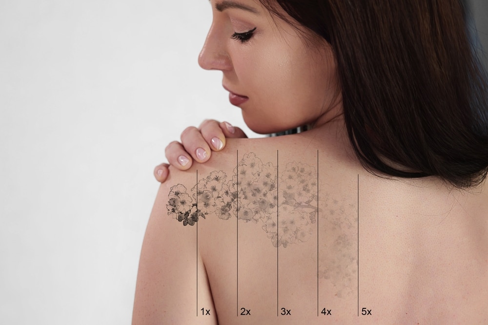 Laser tattoo removal procedure being performed on a woman's shoulder as part of medical skin treatment.